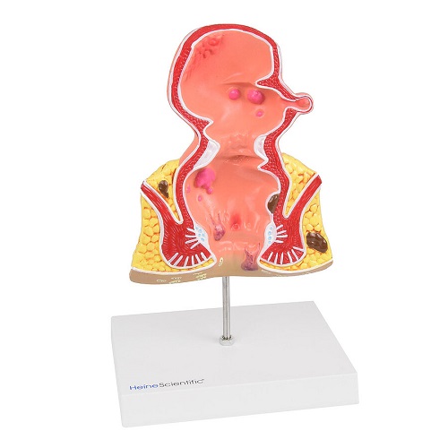 Rectum Pathologies Model